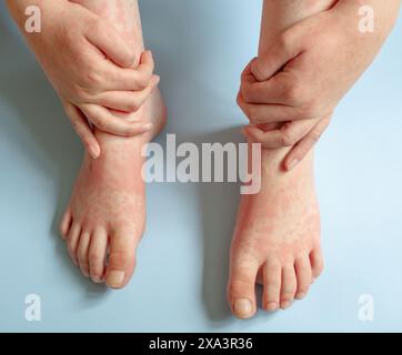 Skin rash due to allergic reaction on antibiotics, boys hands holding his feet on light blue background, medical concept Stock Photo