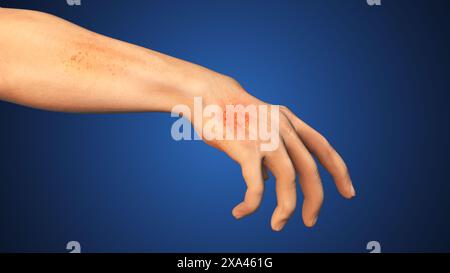 Medical Concept of eczema on hand skin Stock Photo