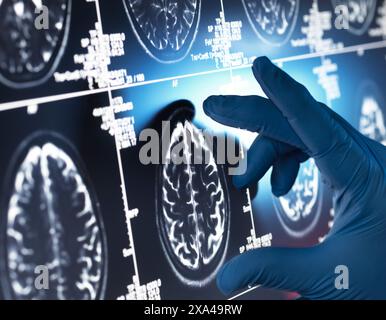 Neurology Research, Doctor examining a human brain scan on screen Stock Photo