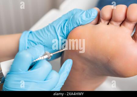 Close up callus removal using electric drill on a womans foot at the medical center Stock Photo