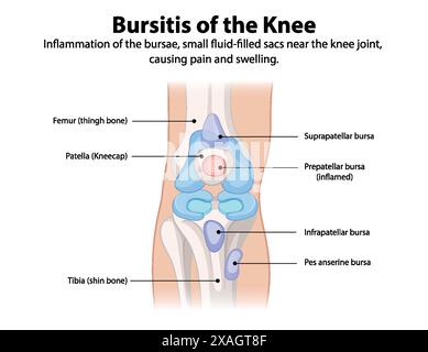 Inflammation of knee bursae causing pain and swelling Stock Vector