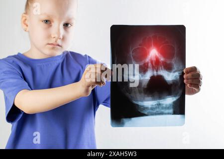 X-ray of sinusitis in a child. Inflammation of the nasal sinuses with ...