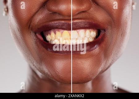 Transformation: From Yellow to Pearly Whites - A Dental Journey Before, During, and After Treatment by African American Dentist. Stock Photo