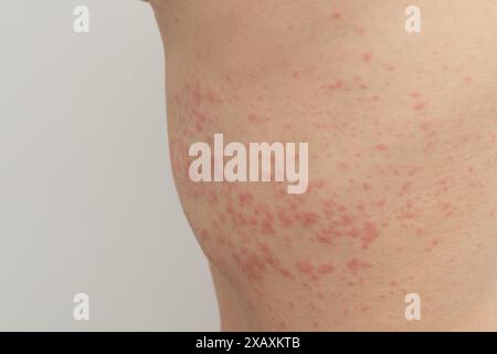 Urticaria is an allergic reaction on the skin. Red spots on the skin Stock Photo
