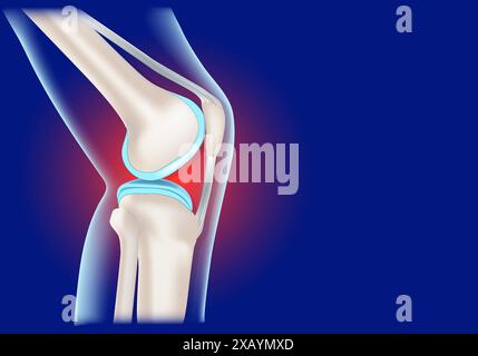 Knee joint inflammation. Realistic human knee on blue background. Concept vector illustration Stock Vector