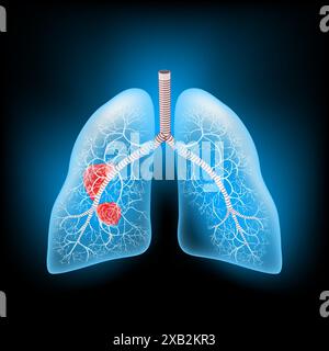 Lung cancer. Realistic transparent blue human lungs with tumor or Metastasis. Glowing effect on dark background. Vector illustration like X-ray image Stock Vector