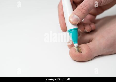 fungal nail infection treatment with pen close up isolated on white copy space, male hand applying, man applies treatment to cure toenail fungus (onyc Stock Photo