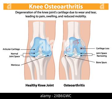 Knee osteoarthritis. Joint degeneration. Vector illustration Stock ...