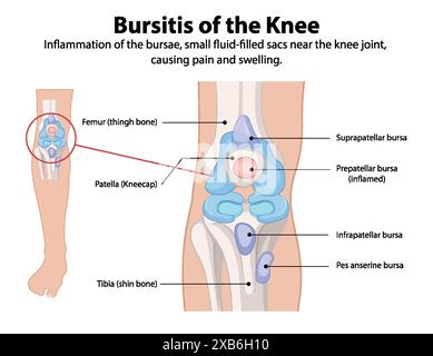 Inflammation of knee bursae causing pain and swelling Stock Vector