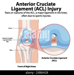 Illustration of ACL tear in the knee Stock Vector