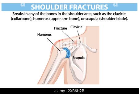 Diagram of shoulder bones and fracture locations Stock Vector