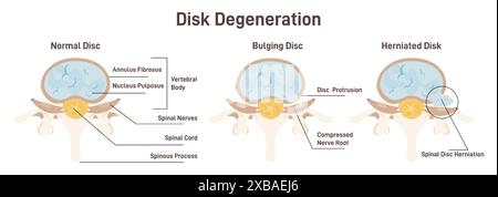 Disc degeneration stages set. flat Spine vertebrae anatomy scheme, healthy lumbar and medical conditions - bulging and herniated disc. Educational medical information. Flat vector illustration Stock Vector