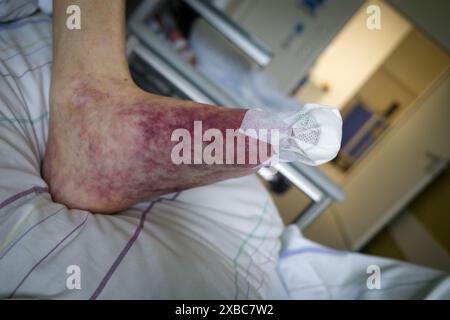 A patient with a foot with impaired blood circulation has a bandage on the toe Stock Photo