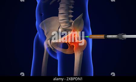 Anatomy Human Hip Joint Treatment Stock Photo