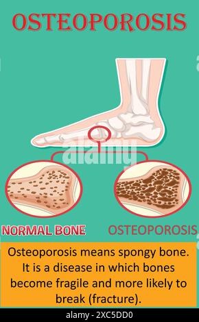 healthy and with osteoporosis. Cartoon Color Osteoporosis Bones Ad Poster Card Skeletal Health Concept Flat Design. Stock Vector