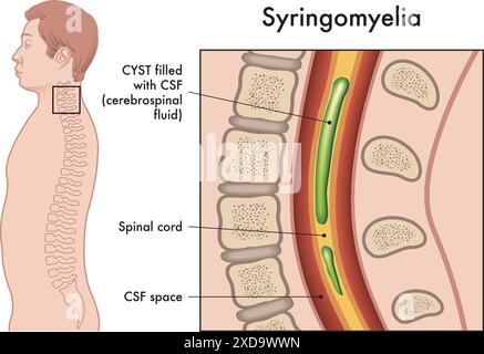 Medical illustration shows the symptoms of Syringomyelia, a pathology that affects the spine. Stock Vector