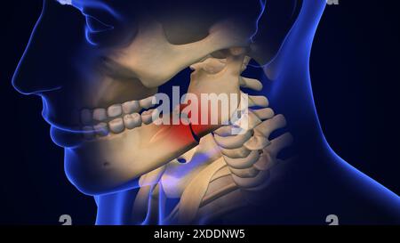 Broken Jaw joint with Metal Plate and Screws Stock Photo