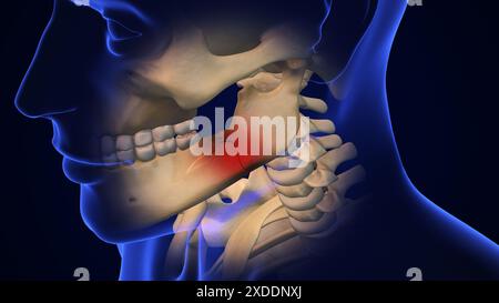 Broken Jaw joint with Metal Plate and Screws Stock Photo