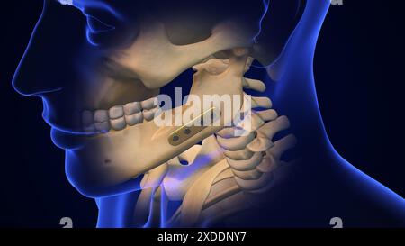 Broken Jaw joint with Metal Plate and Screws Stock Photo