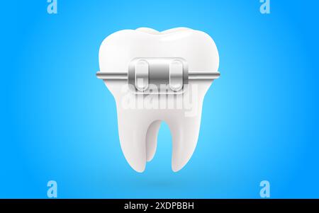 Vector human teeth with metal braces and whitening tray side view ...