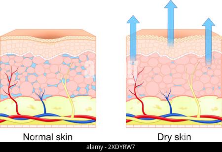 Dry and normal skin. Cross section of human skin. Loss of moisture in human skin. Vector illustration Stock Vector