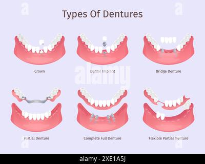 Dentures types. Tooth biting restorations dental care prosthesis teeth implant partial bridge complete full removable denture plastic crown, dentistry swanky vector illustration Stock Vector
