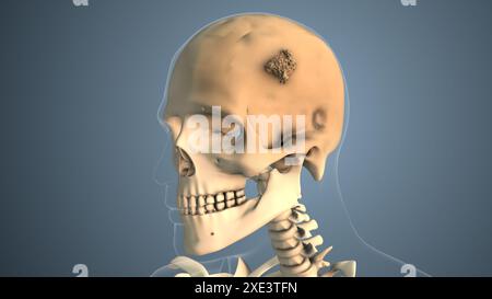 Cancer spreading along a skull bone Stock Photo