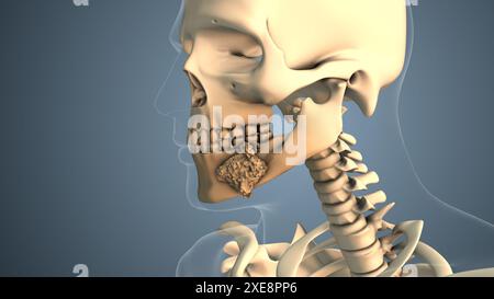 Cancer spreading along a mouth bone Stock Photo