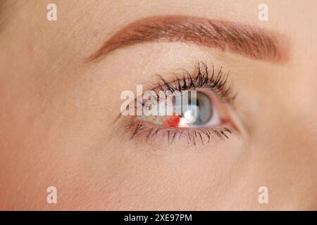 Blue eye on the right side of a woman, without identifying the person, with ocular hemorrhage, highlighting the red bleeding in this eye. Stock Photo