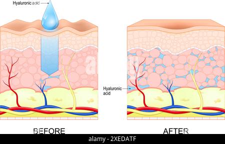 Hyaluronic acid. Skin rejuvenation. Wrinkles Before and after hyaluronic acid use. Vector illustration Stock Vector