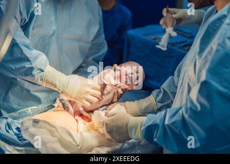 A baby is delivered during a caesarean section. The surgical procedure is conducted in a sterile operating room with a skilled medical team, ensuring Stock Photo