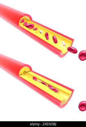 Anatomical 3D illustration of an artery that is becoming blocked by accumulated fat. Slows down red blood cells and platelets in blood circulation. Stock Photo