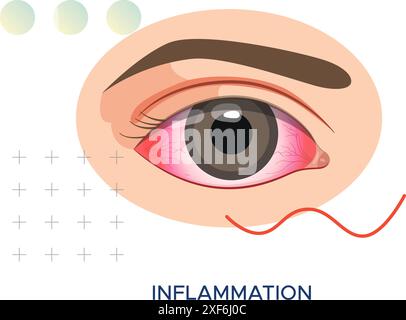 Eye Inflammation due to Infection - Pink Eye - Stock Illustration as EPS 10 File Stock Vector