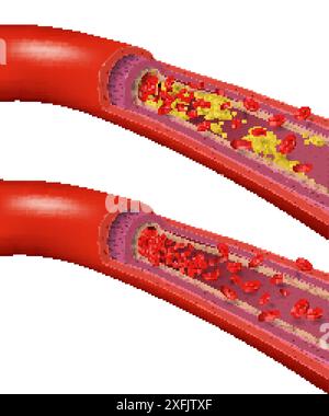 Healthy and blocked blood vessels illustration Stock Vector Image & Art ...