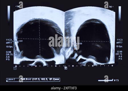 Ultrasound image of large round cyst in lower abdomen of woman printed on a piece of paper Stock Photo