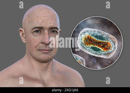 Illustration of a man with a rash caused by infection with a pox virus (family Poxviridae) and a close-up of one such virus particle. Four genera of Poxviridae can infect humans: Orthopoxvirus, Parapoxvirus, Yatapoxvirus and Molluscipoxvirus. These genera contain prevalent viruses such as Mpox, smallpox (now eradicated bar laboratory populations) and vaccinia virus. Stock Photo