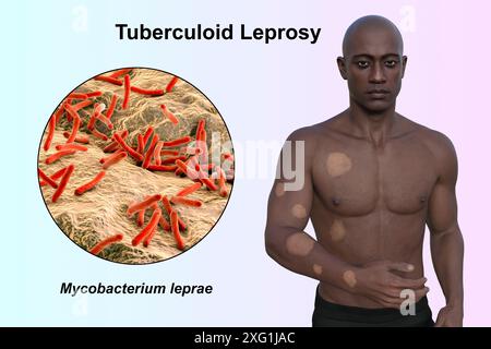 Illustration of a man with hypopigmented lesions on his arm and trunk ...