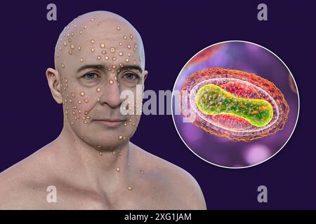 Illustration of a man with a rash caused by infection with a pox virus (family Poxviridae) and a close-up of one such virus particle. Four genera of Poxviridae can infect humans: Orthopoxvirus, Parapoxvirus, Yatapoxvirus and Molluscipoxvirus. These genera contain prevalent viruses such as Mpox, smallpox (now eradicated bar laboratory populations) and vaccinia virus. Stock Photo