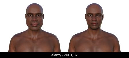 Illustration comparing a man with acromegaly (left) and the same healthy man (right). Acromegaly is a condition causing an increase in the size of the hands and face due to the overproduction of somatotrophin (human growth hormone). It is typically a result of a benign tumour (adenoma) forming on the pituitary gland. Stock Photo