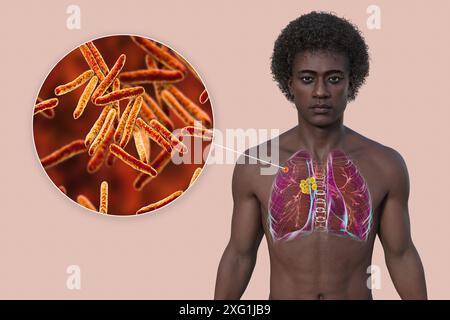 Illustration of a man's thoracic (chest) cavity revealing a Ghon complex (yellow/orange) in the lungs caused by tuberculosis, and a close-up view of the causative bacteria Mycobacterium tuberculosis. A Ghon complex is a lesion in the lungs consisting of swollen lymph nodes which contain bacteria. Tuberculosis is a bacterial infection of the lungs. It can be serious if left untreated but antibiotics typically resolve the infection. Stock Photo