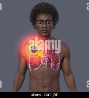 Illustration of a man's thoracic (chest) cavity revealing a Ghon complex (yellow/orange) in the lungs caused by tuberculosis. A Ghon complex is a lesion in the lungs consisting of swollen lymph nodes which contain bacteria. Tuberculosis is a bacterial infection of the lungs. It can be serious if left untreated but antibiotics typically resolve the infection. Stock Photo