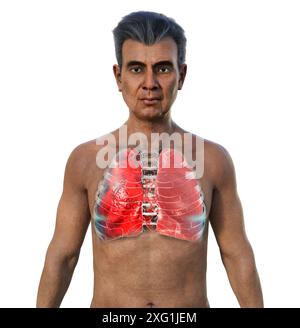 Illustration of a man's thoracic (chest) cavity showing one healthy lung (right) and one lung affected by pneumonia (left). Pneumonia is a bacterial infection. If the lungs are infected, it causes the alveoli (air sacs) to become inflamed and fill with pus. Stock Photo