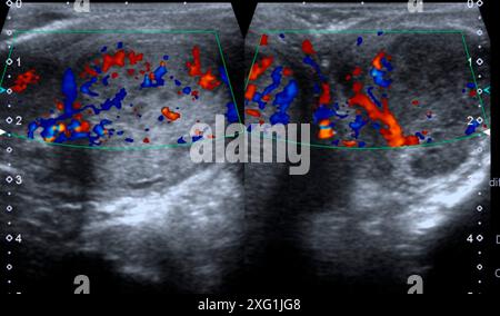 Ultrasound scan showing orchitis, an infection of the testicles. The ...