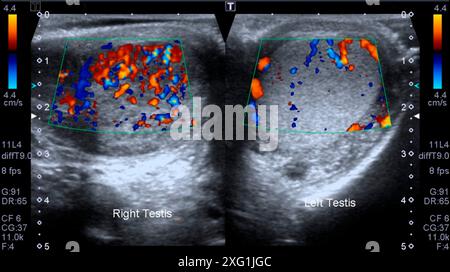 Ultrasound scan showing orchitis, an infection of the testicles. The ...