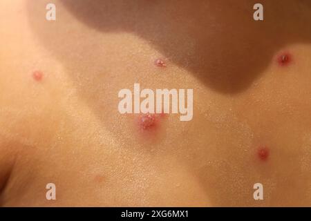 Young child with chicken pox (aka varicella) virus blisters Stock Photo