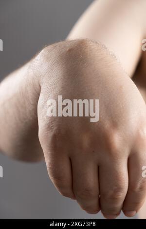 Ganglion Cyst Or Hygroma Of The Wrist On The Hand Of A Male Patient ...