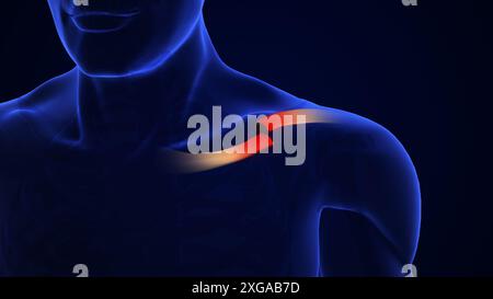 Clavicle Bone Fracture medical concept Stock Photo