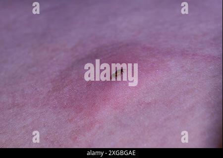 beetle on the human skin. parasite close-up Stock Photo - Alamy