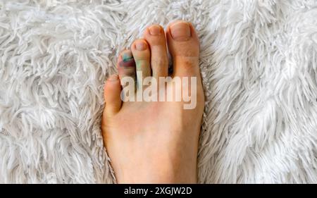 Male leg with a bruise on the toe. Stock Photo