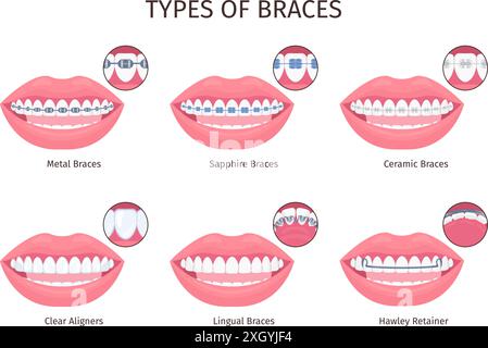 Braces types. Dental bracket teeth retainer type, metalic plastic ceramic invisible sapphire brace aesthetic tooth mouth, orthodontic aligner infographic swanky vector illustration Stock Vector